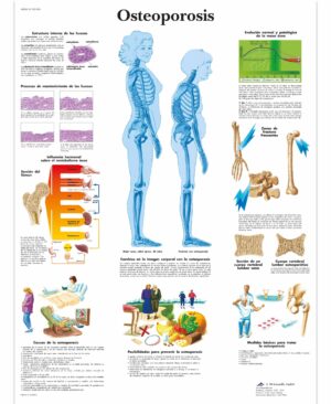 Osteoporosis lámina