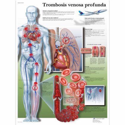 Trombosis venosa profunda Lámina