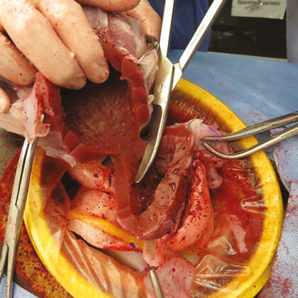 Simulador obstétrico de histerectomía de urgencia durante una cesárea C-Celia