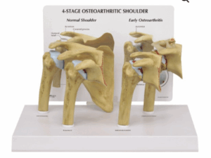 4 Etapas Osteoartritis en Hombro