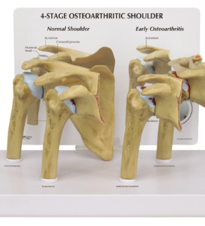 4 Etapas Osteoartritis en Hombro