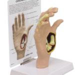 Mano con Osteoartritis