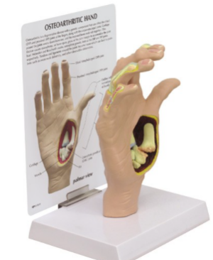 Mano con Osteoartritis