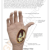 Mano con Osteoartritis - Imagen 5