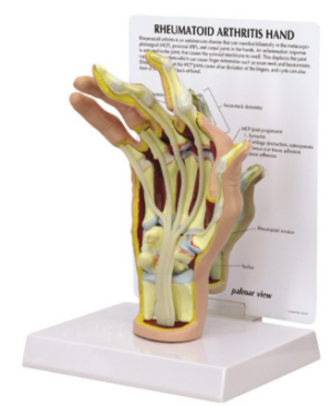 Mano con Artritis Reumatoide