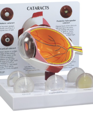 Ojo con Cataratas