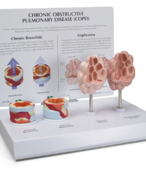 EPOC Enfermedad Pulmonar Obstructiva