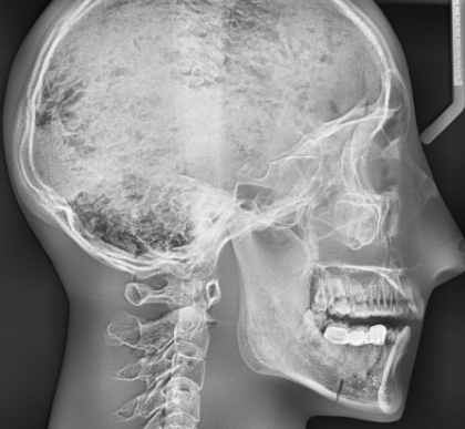 Phantom para Rx de Cabeza con Vertebras Transparente - Imagen 6