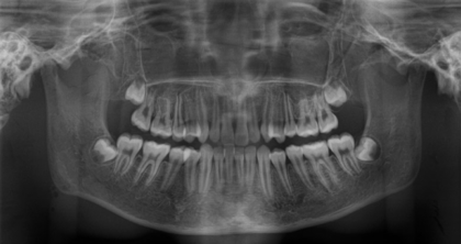 Phantom para Rx de Cabeza con Vertebras Transparente - Imagen 5